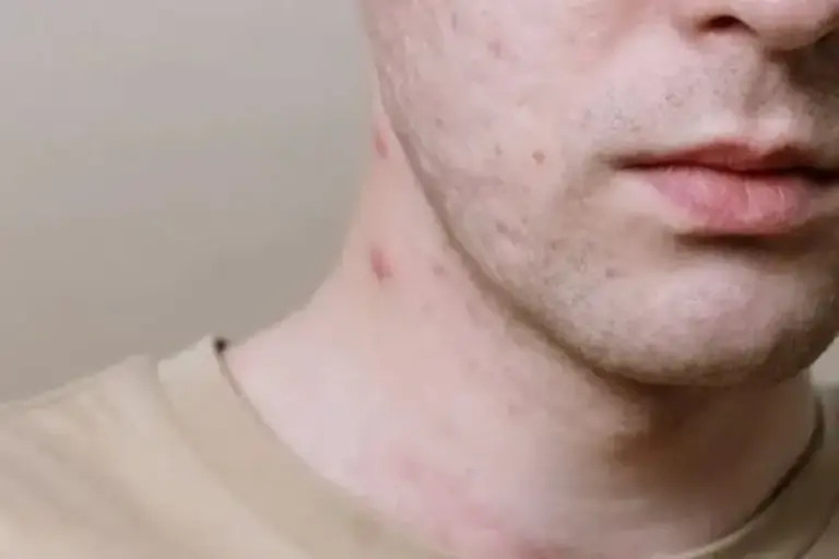 Jerawat di Leher Tiba-tiba Muncul di Usia 40, Ini Sebabnya