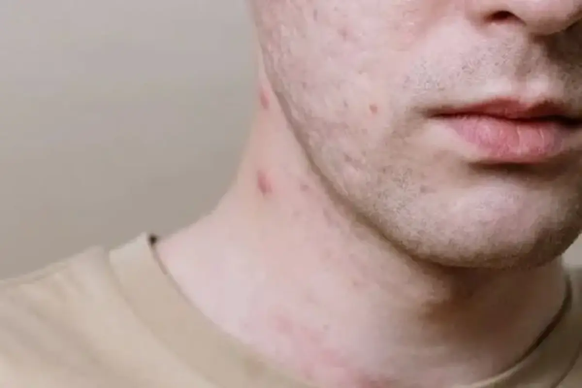 Jerawat di Leher Tiba-tiba Muncul di Usia 40, Ini Sebabnya